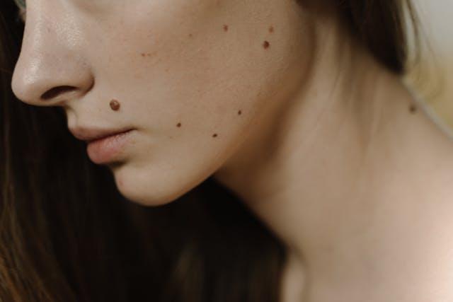 Mole Ribnica When to Worry About Moles and Recognise Signs of Concern
